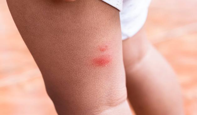 איך להתמודד עם עקיצות יתושים? צילום: dintadonna,Shutterstock לייף סטייל