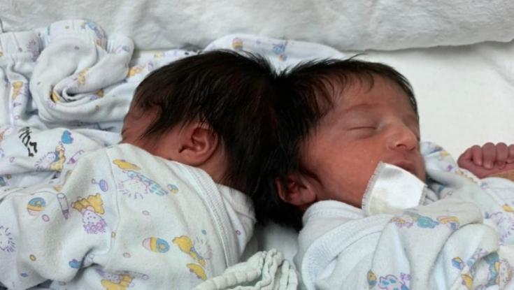 תאומות סיאמיות: ניתוח ראשון בישראל להפרדת תאומות המחוברות בראשן