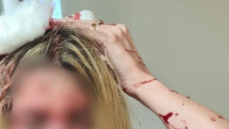 "ניסיון רצח": הוארך מעצר החשוד שתקף רופאה בפטיש ופצע אותה בינוני