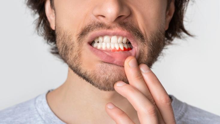 אילו תרופות סבתא יכולות לסייע לדלקת חניכיים?