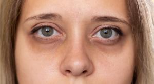 כהויות מתחת לעיניים צילום: Marina Demeshko,Shutterstock טיפוח
