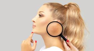 פיגמנטציה צילום: shutterstock טיפוח