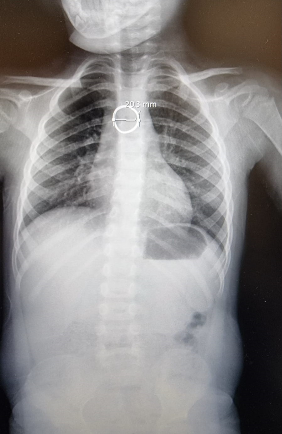 צילום הרנטגן של הטבעת בגוף הילדה