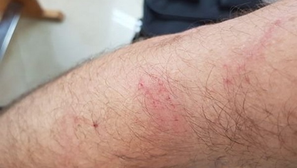 החבלות שעל ידו של ראש עיריית לוד